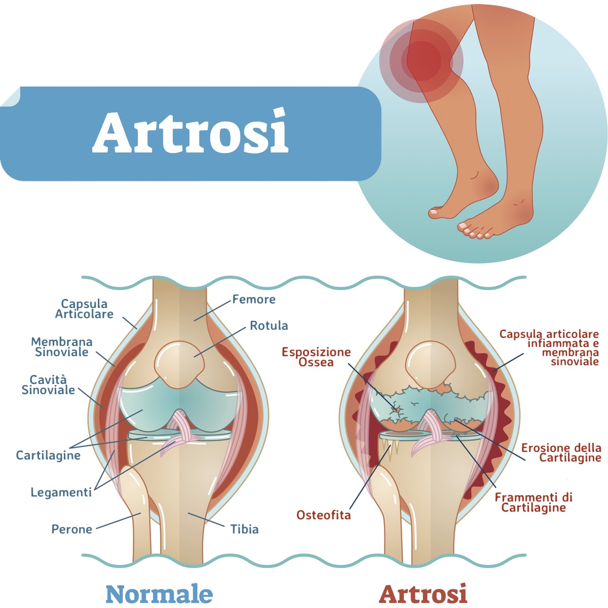 Artrosi