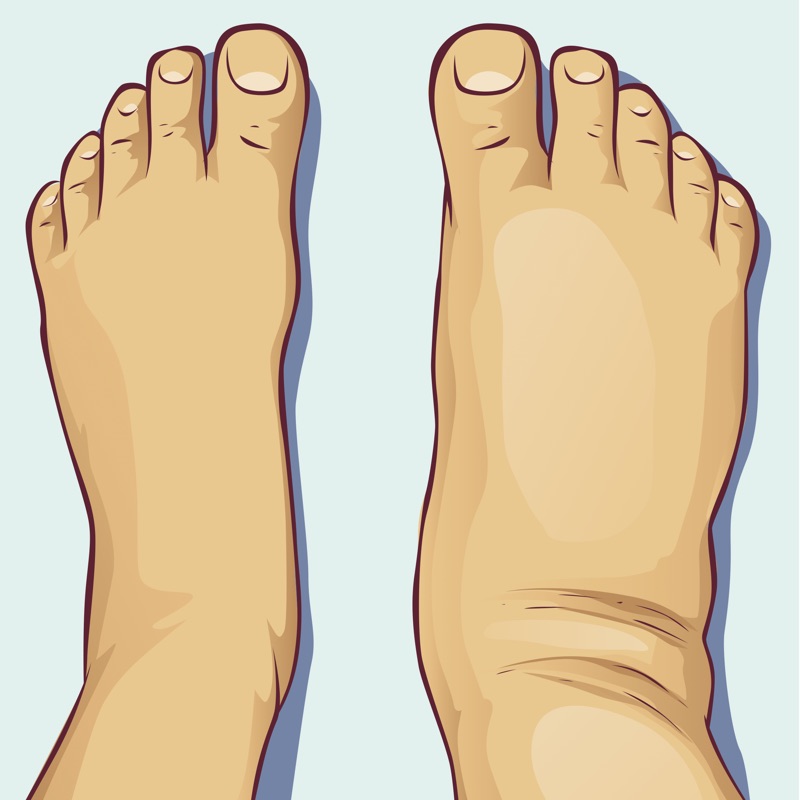 Edema