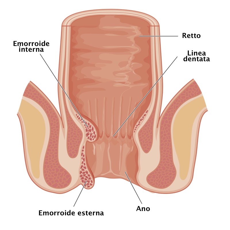Emorroidi Emorroidi