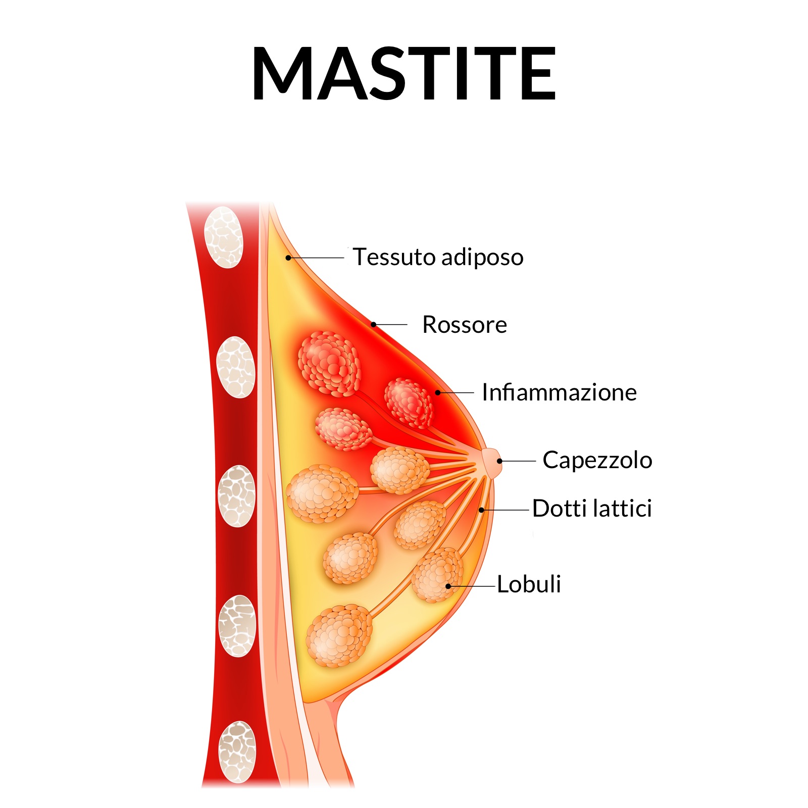 Mastite Mastite