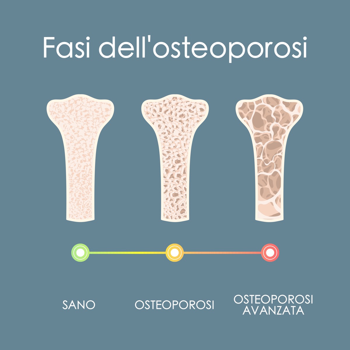 Osteoporosi Osteoporosi